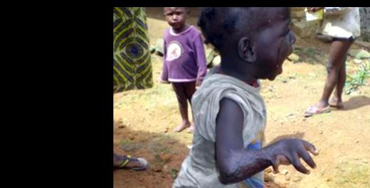 Epilepsy Myths Promote Stigma, Prevent Care in Cameroon